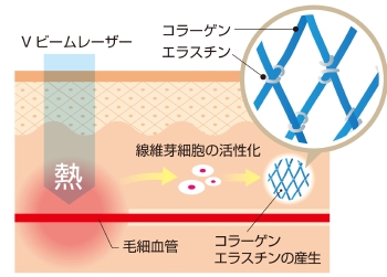 Vビームレーザーの説明画像